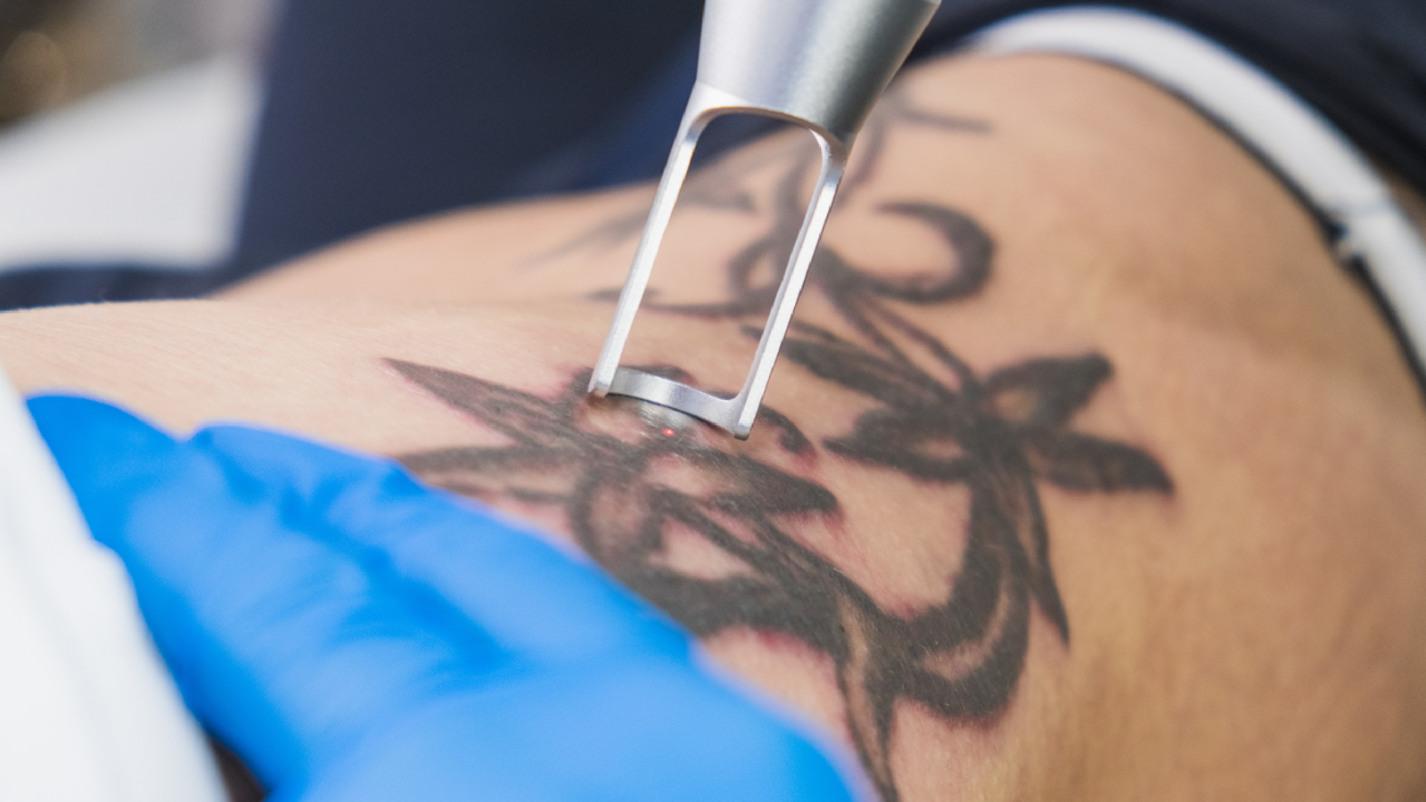 Tattoo Removal CU_1600x900